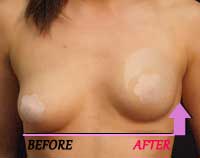 A-F cup breast